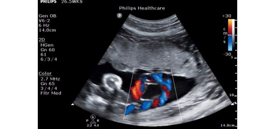 Philips ClearVue 650