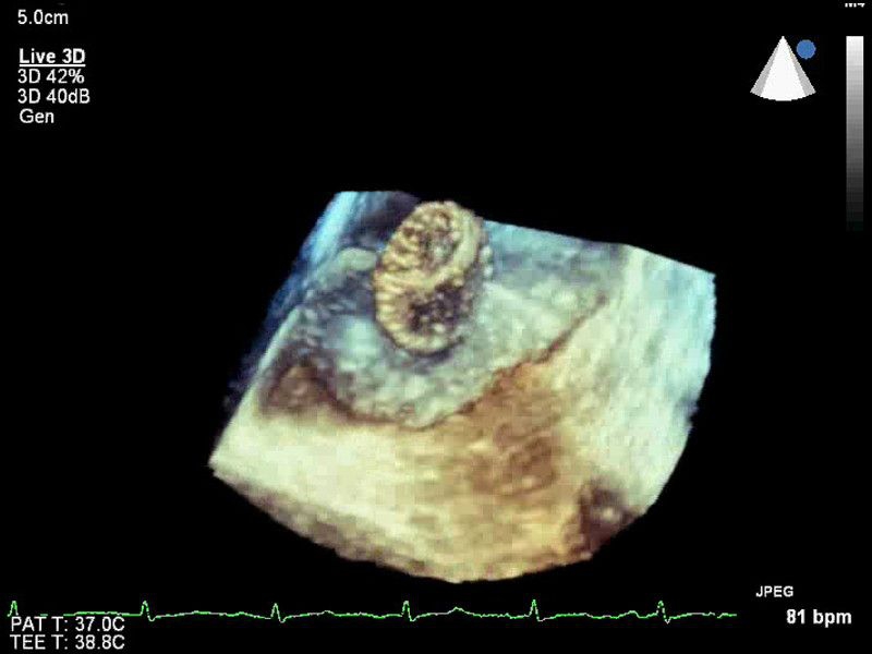 Philips iE33 xMatrix